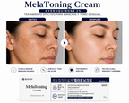 MelaToning Cream Hydroquinone 2% | Hyperpigmentation & Dark Spot Treatment | 30g