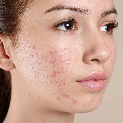 Acne / Sensitive Skin